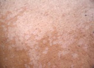 Tinea-pityriasis-versicolor