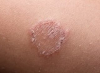 tinea-corporis